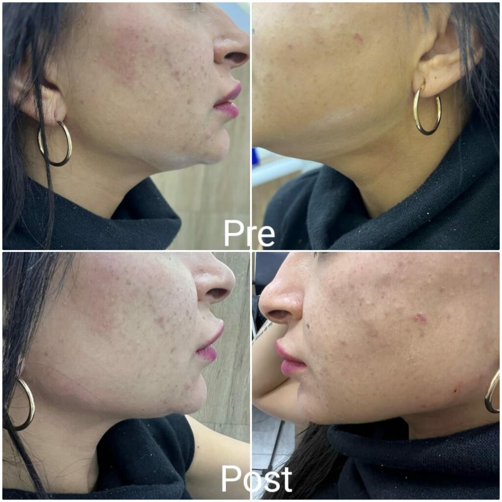 تحديد الفك قبل وبعد